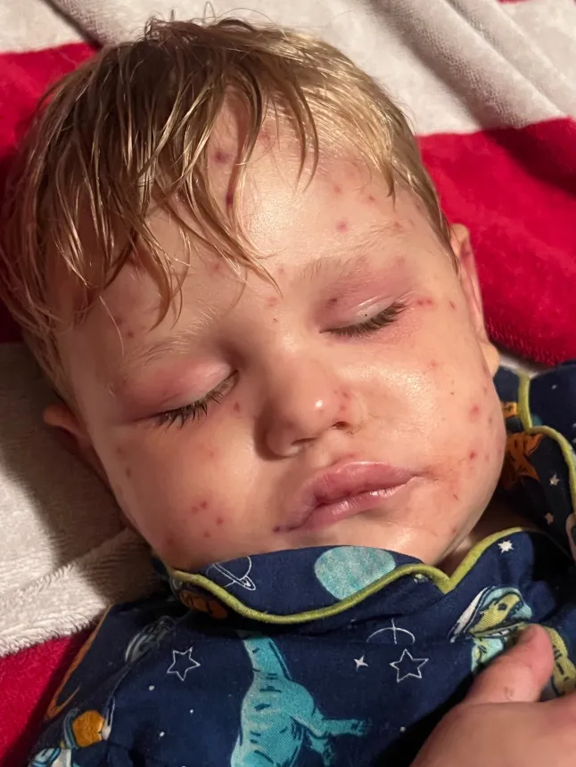 Toddler, 2, Is on Life Support After Being Stung Over 150 Times