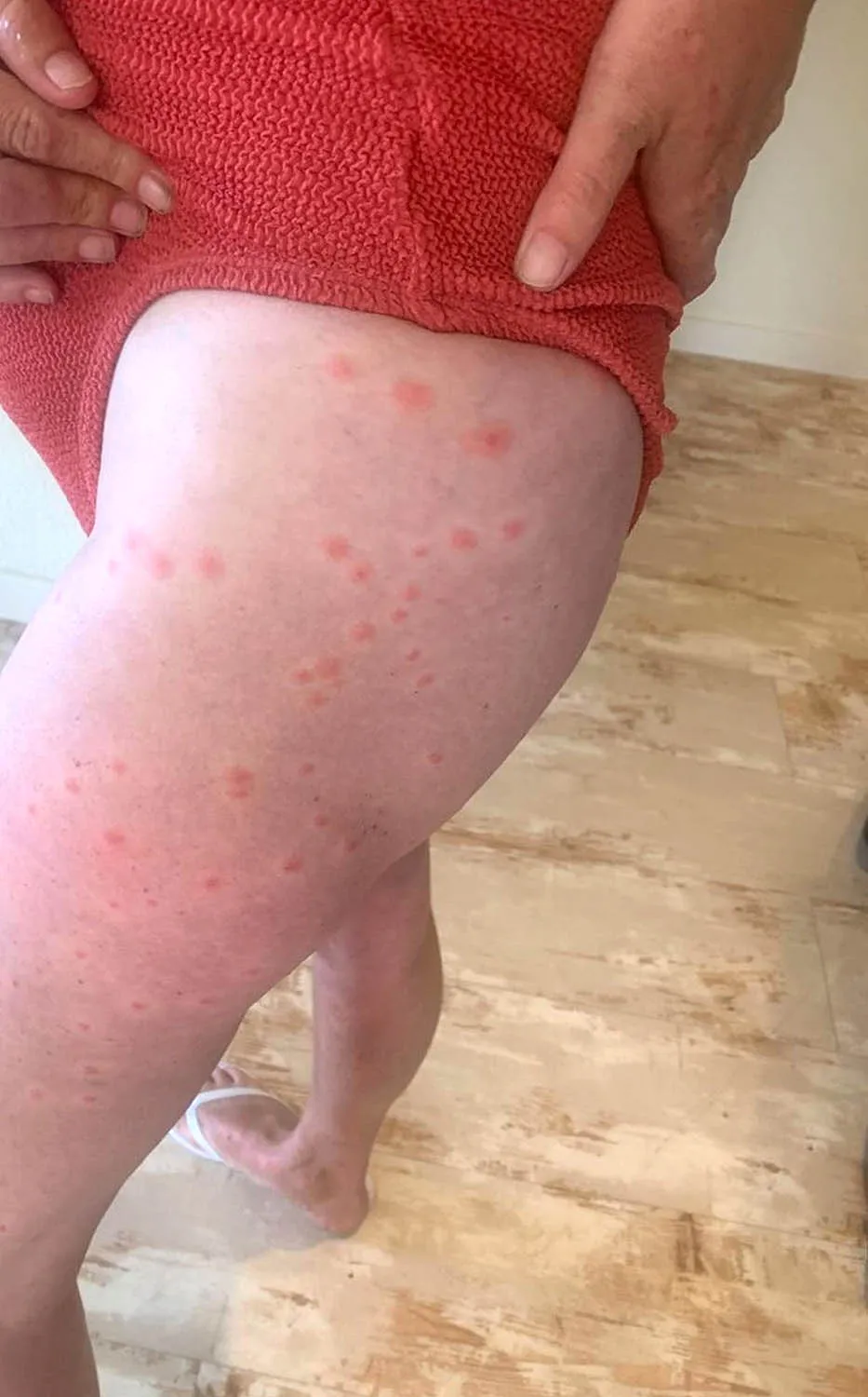 Vacationing Mom Collapses, Falls Down Stairs, Hits Head and Fractures Neck After ‘Dozens and Dozens’ of Mosquito Bites